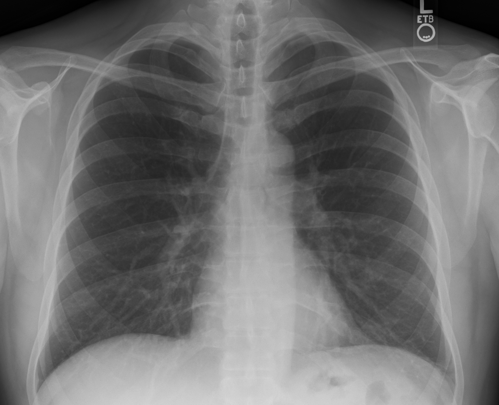 A frontal chest X-ray showing the lungs, heart and ribs